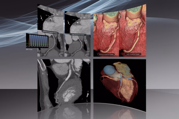 Scanner Cardiaque